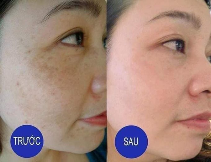 Review Kem Trị Nám Clobetamil G Cao Cấp Thái Lan | Bộ 4 Sản Phẩm Chuyên Trị Nám, Tàn Nhang